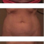 Several progress images of a stomach going through coolsculpting accent therapy