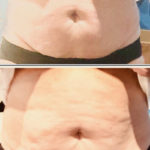 A before and after comparison of a stomach before and after coolsculpting accent therapy