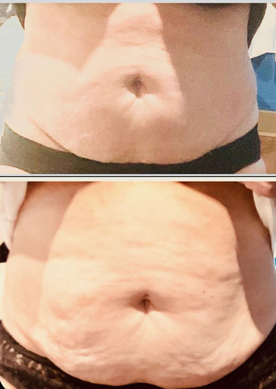 RF Body Contouring North Vancouver
