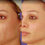 Pixel Laser Skin Resurfacing at Laser & Wellness Center in Vancouver WA
