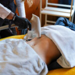 Accent Skin Tightening performed on stomach of Laser & Wellness Center patient as she lays on a couch.